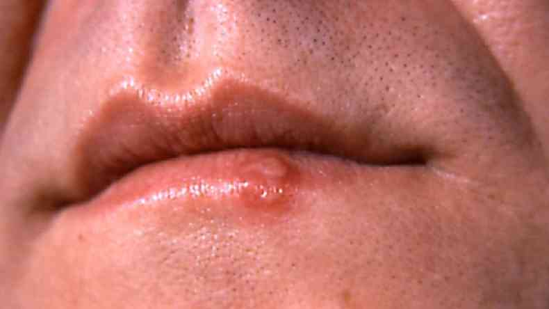 Herpes labial