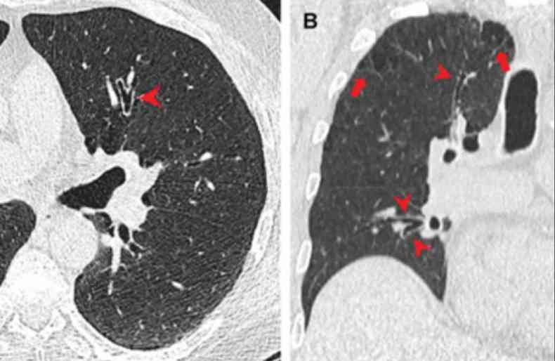 Enfisema pulmonar 