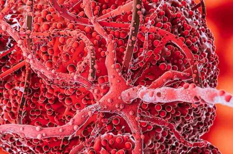 O mieloma mltiplo  um cncer hematolgico que afeta as clulas produtoras de anticorpos