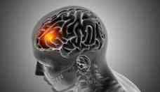 Como saber se está com um aneurisma cerebral? Confira os sintomas