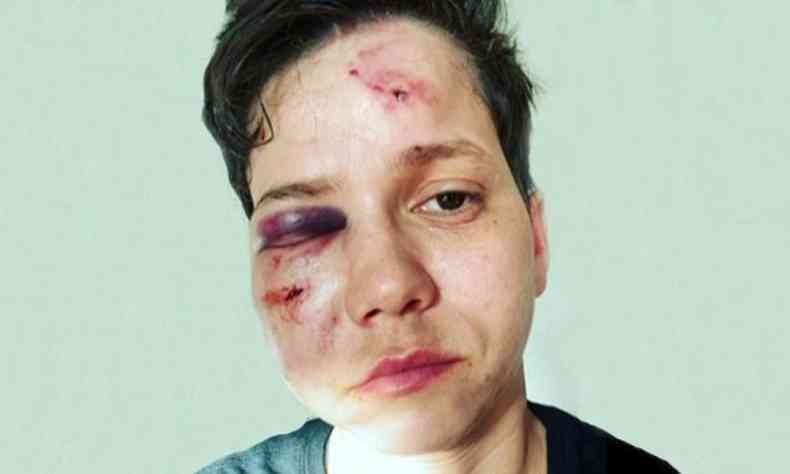 Karol Eller teve o rosto desfigurado aps receber vrios socos no rosto e pontaps(foto: Reproduo/Facebook)