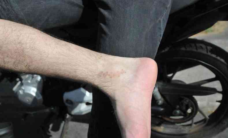 Edson Ribeiro, que trabalha de motoboy na Grande BH, mostra cicatriz aps acidente