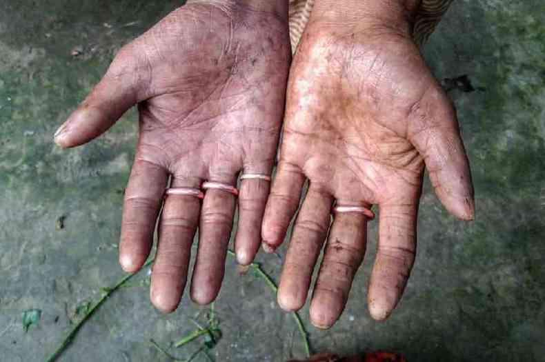Dedos de Amal Sarker no tm padres distintos encontrados na maioria das pessoas(foto: BBC)