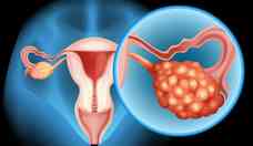 Teratoma: o que  o tumor nos ovrios que pode ter dentes, cabelo e unha