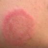 Exame micológico é recomendado para detectar a presença de fungos no verão