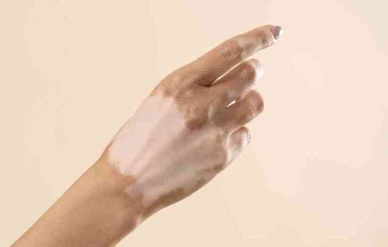 Mão com vitiligo