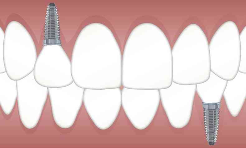 ilustrao de dentes, dois deles com a haste do implante 