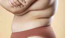 Conhea a doena que causa deformao corporal e  confundida com obesidade