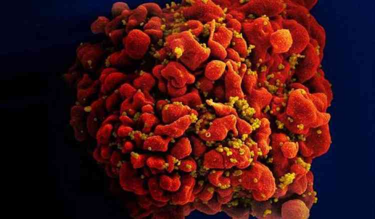 Imagem microscpica de clula contaminada pelo vrus da Aids.