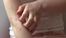 Como lidar com reaes alrgicas nas frias de vero